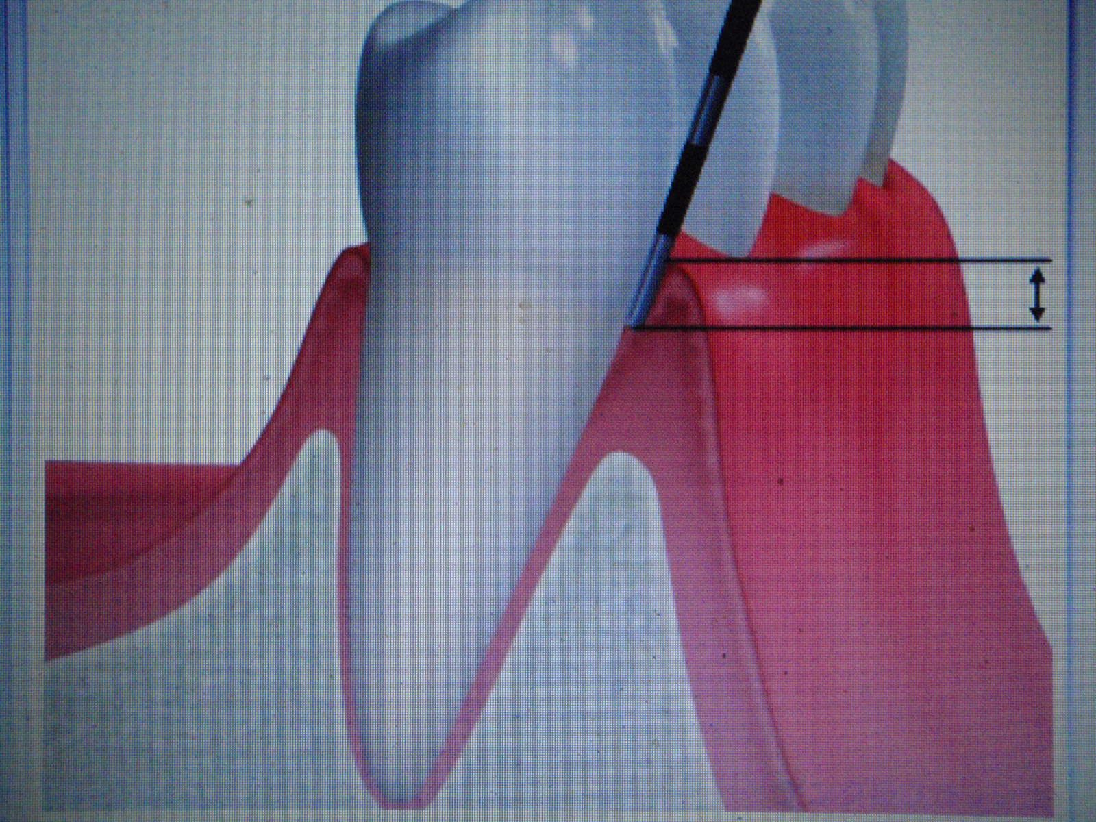 歯肉溝