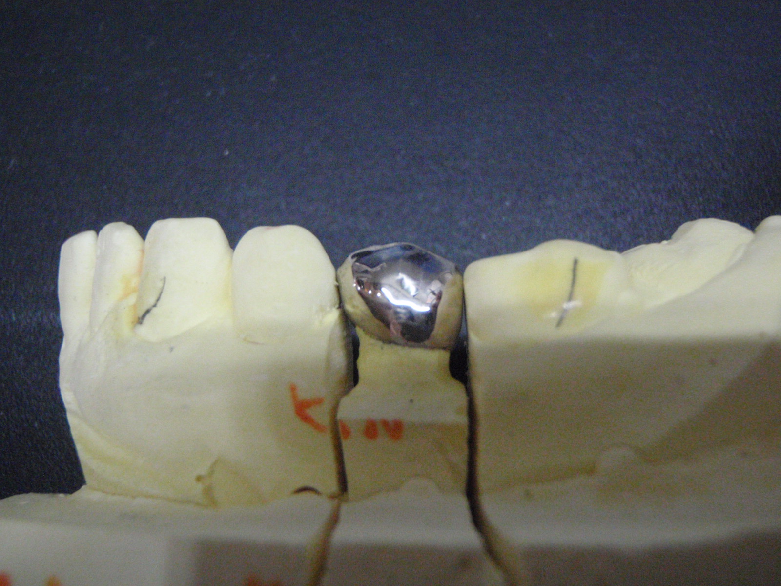 小臼歯の銀歯の被せもの
