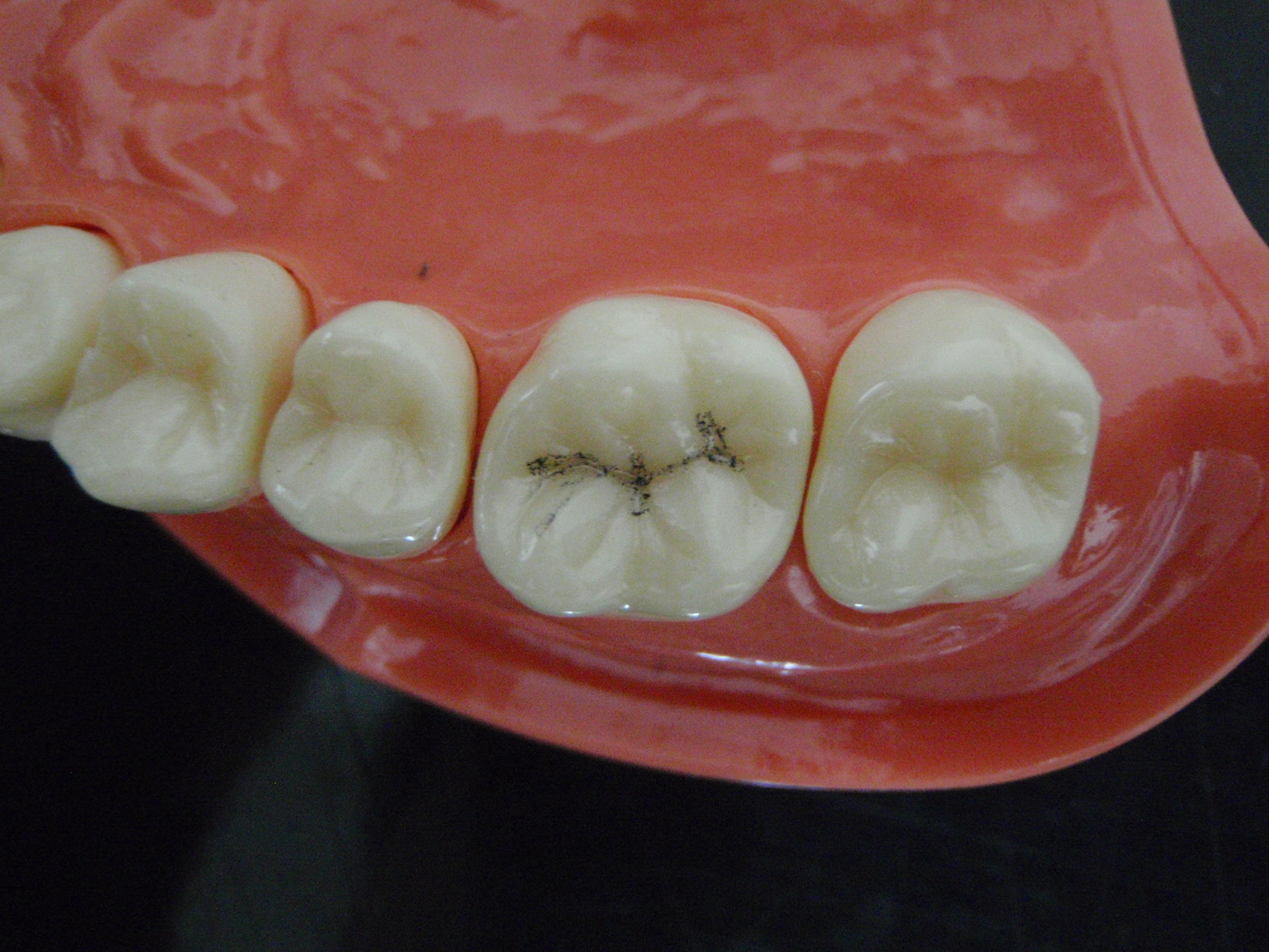 溝の虫歯