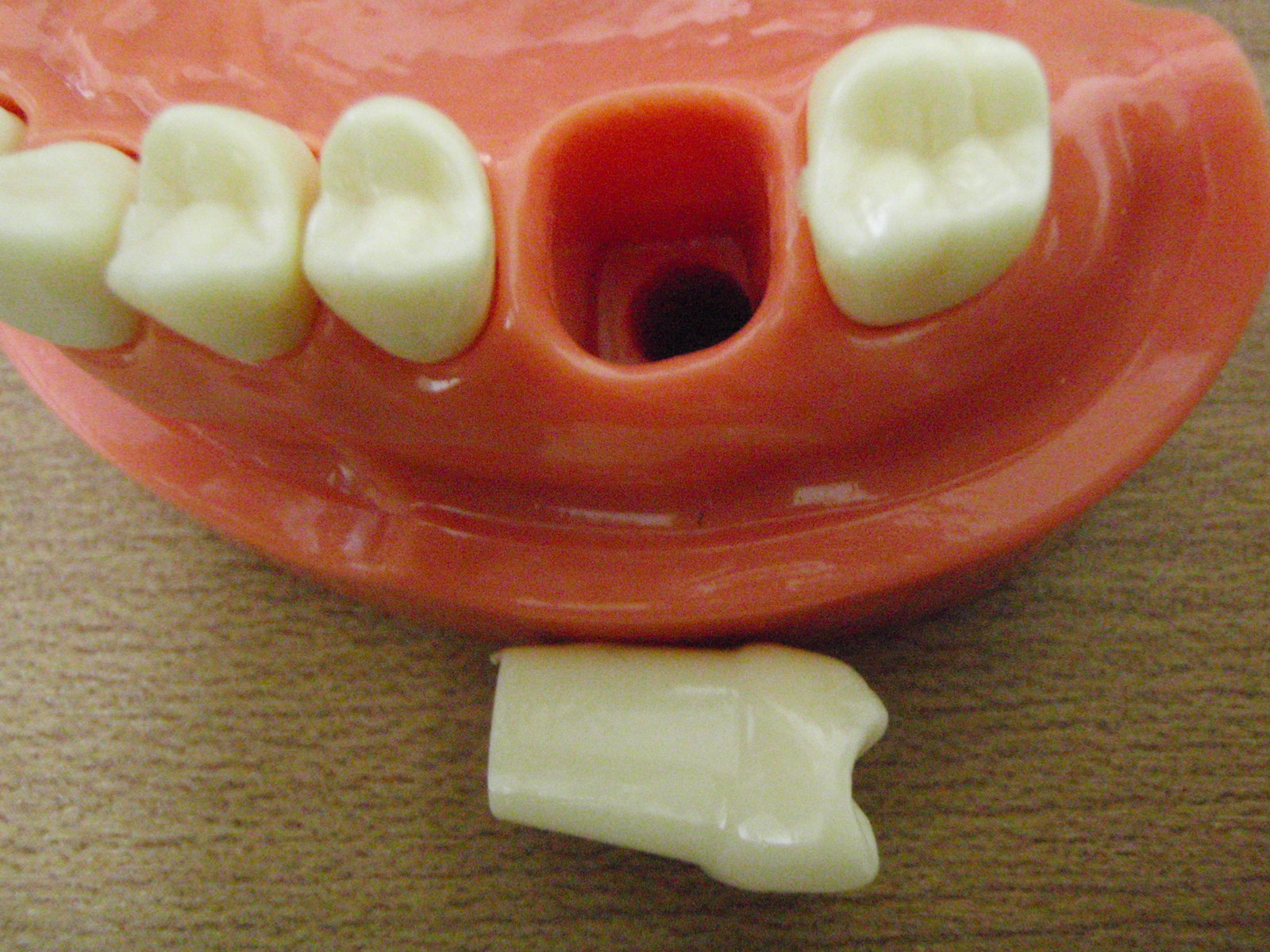 奥歯の抜歯値段
